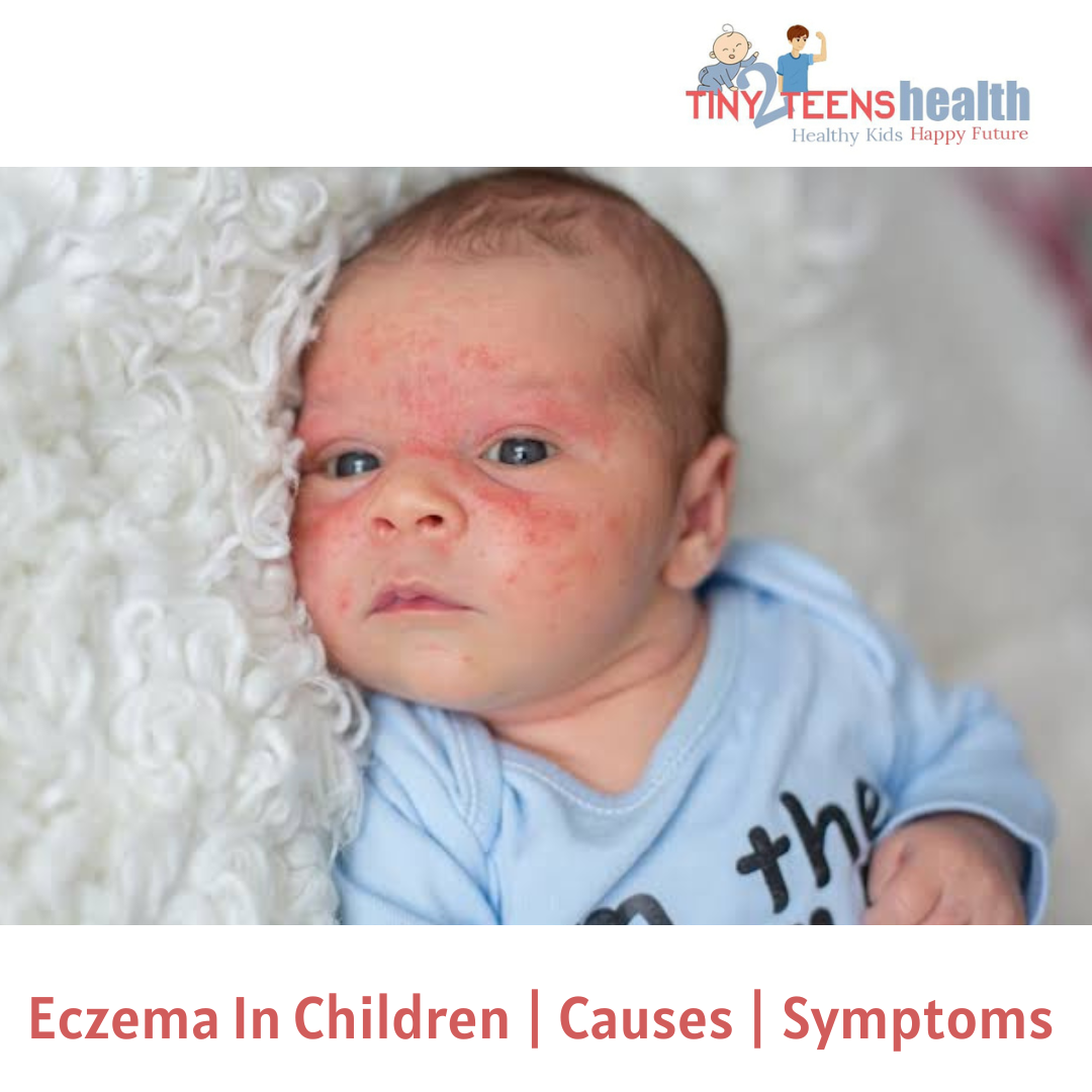 eczema-in-children-causes-symptoms-tiny2teens-health